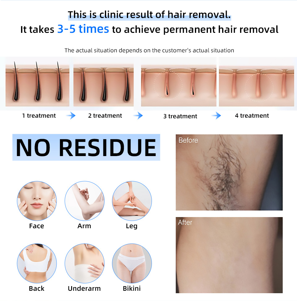 Precio de fábrica 20000000   B - Industrial Laser Hair Removal Machine reseña y precio